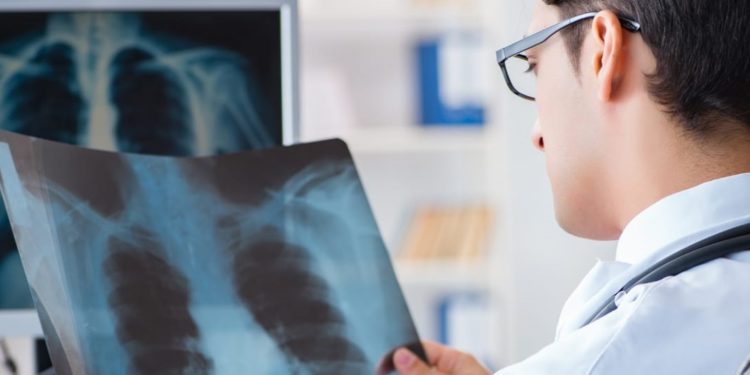 Agosto Branco alerta para o câncer de pulmão