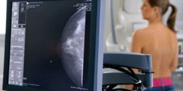 Especialista fala sobre a importância do diagnóstico precoce do câncer de mama