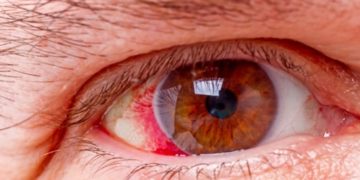 Taxa elevada de gordura no sangue aumenta risco de glaucoma, aponta estudo