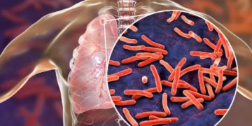 Sesapi alerta para aumento de casos de tuberculose no Piauí